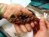 Safra Çamuru Belirtileri ve Tedavisi Safra Çamuru Belirtileri ve Tedavisi