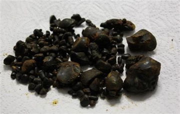 Safra Kesesi Kumu Belirtileri ve Tedavisi Safra Kesesi Kumu Belirtileri ve Tedavisi