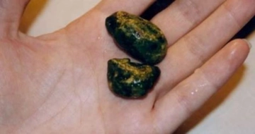 Safra Kesesi Taşı Belirtileri ve Tedavisi Safra Kesesi Taşı Belirtileri ve Tedavisi